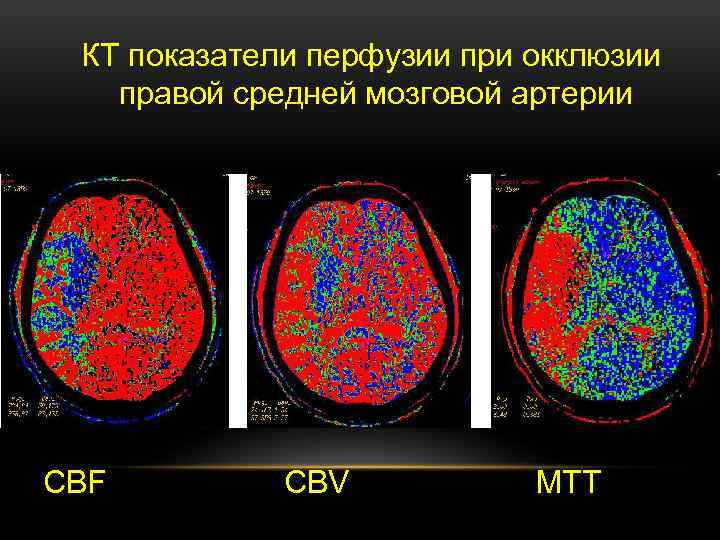 КТ показатели перфузии при окклюзии правой средней мозговой артерии CBF CBV MTT 
