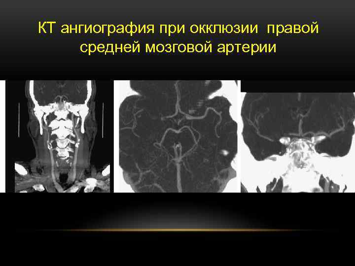 КТ ангиография при окклюзии правой средней мозговой артерии 