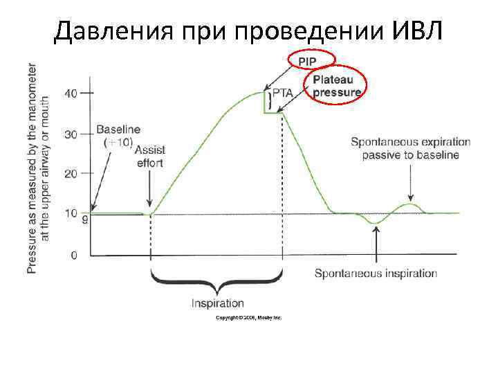 Давления при проведении ИВЛ 