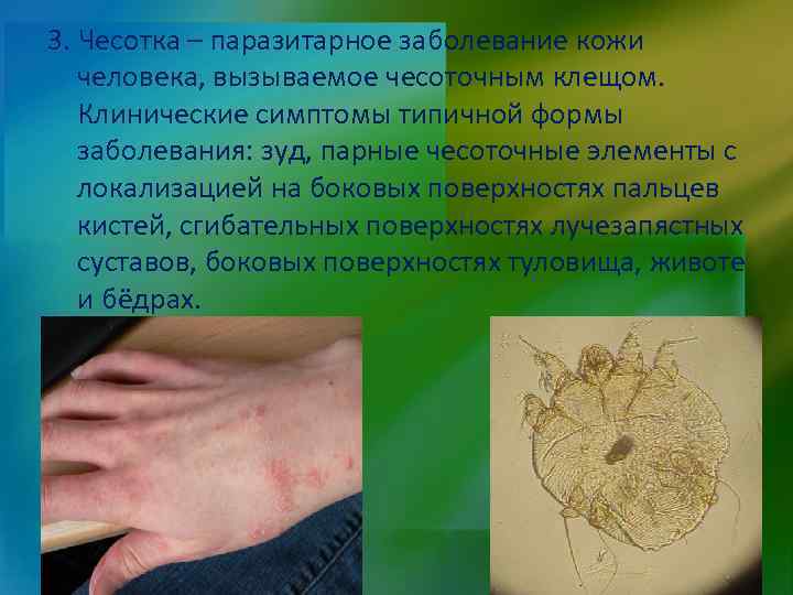 3. Чесотка – паразитарное заболевание кожи человека, вызываемое чесоточным клещом. Клинические симптомы типичной формы