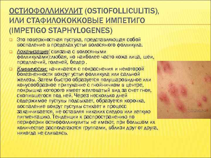 ОСТИОФОЛЛИКУЛИТ (OSTIOFOLLICULITIS), ИЛИ СТАФИЛОКОККОВЫЕ ИМПЕТИГО (IMPETIGO STAPHYLOGENES) q q q Это поверхностная пустула, представляющая