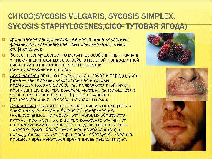 СИКОЗ(SYCOSIS VULGARIS, SYCOSIS SIMPLEX, SYCOSIS STAPHYLOGENES, CICO- ТУТОВАЯ ЯГОДА) q q хроническое рецидивирующее воспаление