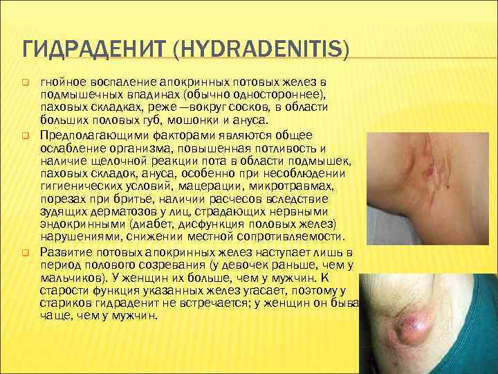 ГИДРАДЕНИТ (HYDRADENITIS) q q q гнойное воспаление апокринных потовых желез в подмышечных впадинах (обычно