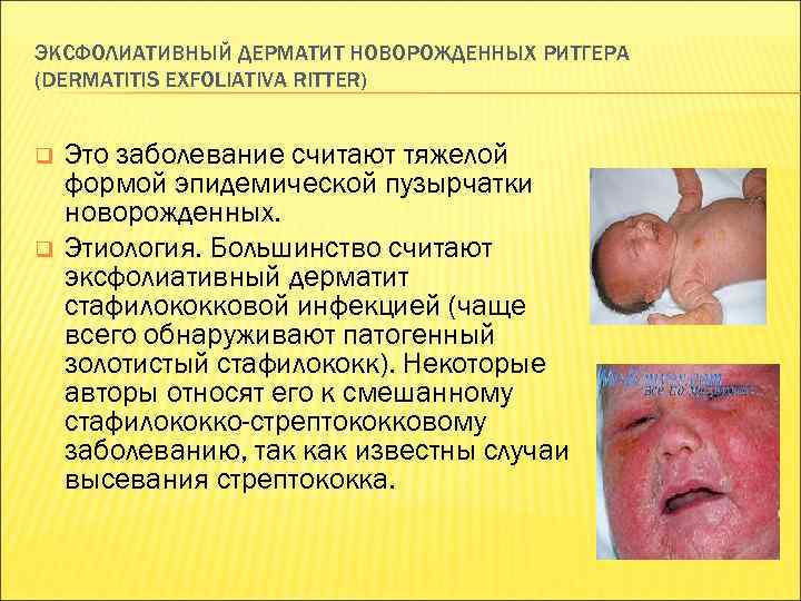 ЭКСФОЛИАТИВНЫЙ ДЕРМАТИТ НОВОРОЖДЕННЫХ РИТГЕРА (DERMATITIS EXFOLIATIVA RITTER) q q Это заболевание считают тяжелой формой