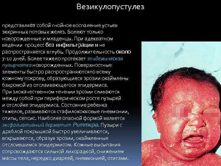 Везикулопустулез представляет собой гнойное воспаление устьев эккринных потовых желез. Болеют только новорожденные и младенцы.