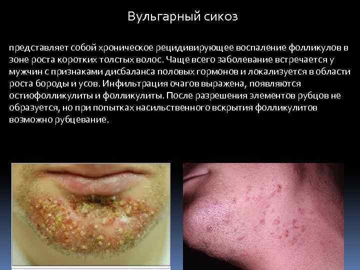 Вульгарный сикоз представляет собой хроническое рецидивирующее воспаление фолликулов в зоне роста коротких толстых волос.