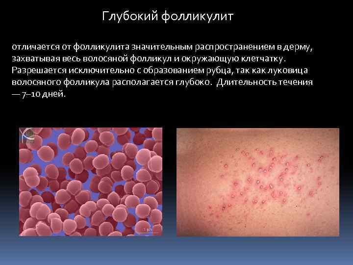  Глубокий фолликулит отличается от фолликулита значительным распространением в дерму, захватывая весь волосяной фолликул