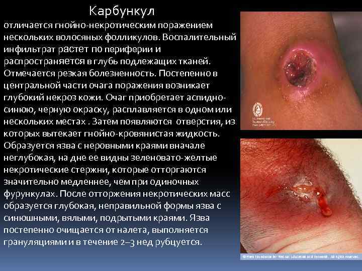 Карбункул отличается гнойно-некротическим поражением нескольких волосяных фолликулов. Воспалительный инфильтрат растет по периферии и распространяется