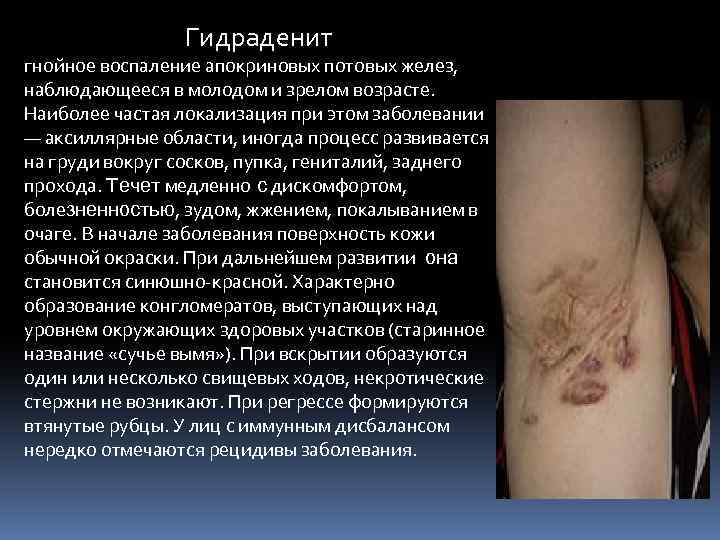 Гидраденит гнойное воспаление апокриновых потовых желез, наблюдающееся в молодом и зрелом возрасте. Наиболее частая