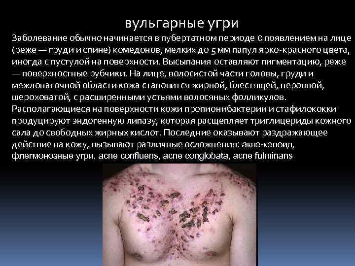 вульгарные угри Заболевание обычно начинается в пубертатном периоде с появлением на лице (реже —