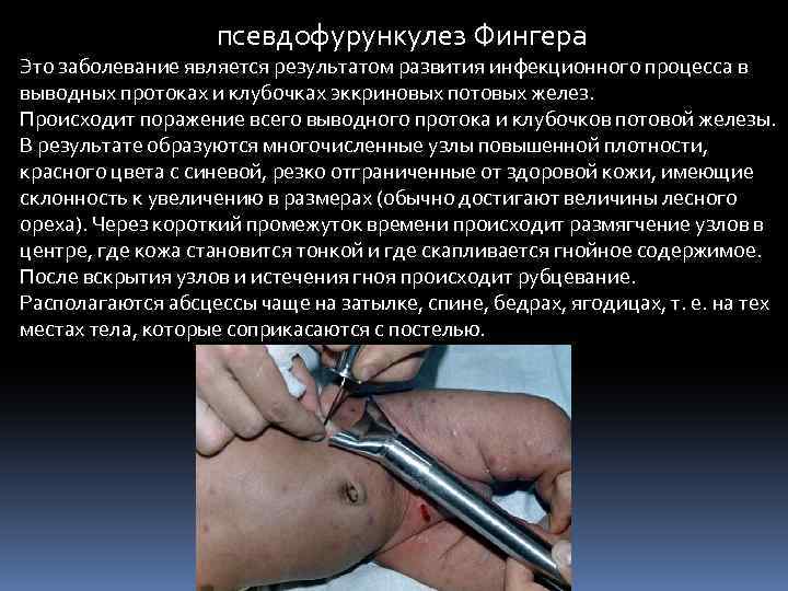  псевдофурункулез Фингера Это заболевание является результатом развития инфекционного процесса в выводных протоках и