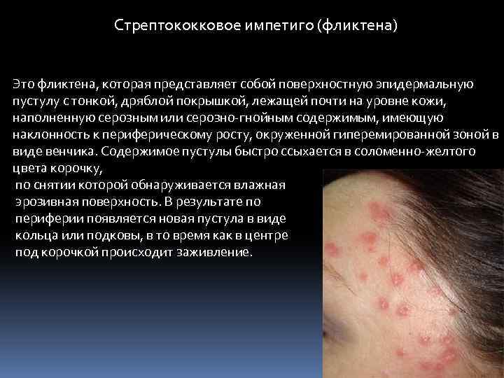Стрептококковое импетиго (фликтена) Это фликтена, которая представляет собой поверхностную эпидермальную пустулу с тонкой, дряблой