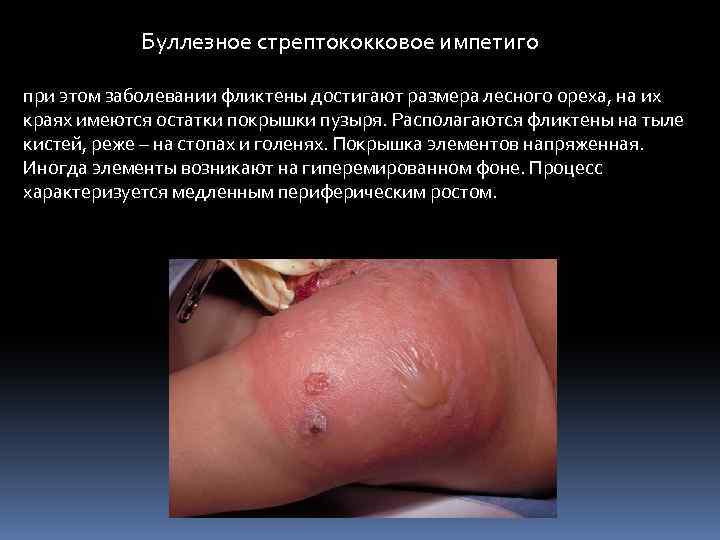 Буллезное стрептококковое импетиго при этом заболевании фликтены достигают размера лесного ореха, на их краях