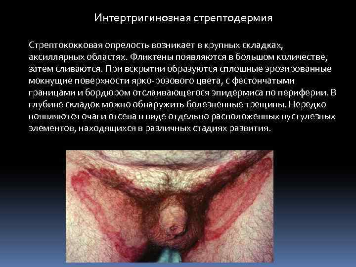 Интертригинозная стрептодермия Стрептококковая опрелость возникает в крупных складках, аксиллярных областях. Фликтены появляются в большом