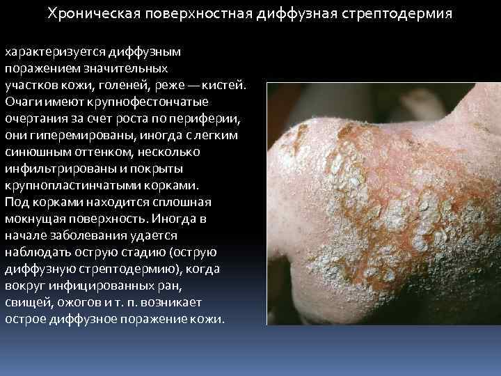 Хроническая поверхностная диффузная стрептодермия характеризуется диффузным поражением значительных участков кожи, голеней, реже — кистей.