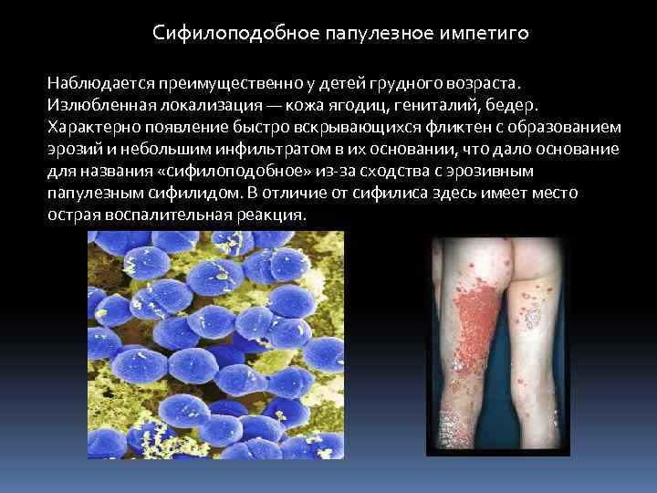  Сифилоподобное папулезное импетиго Наблюдается преимущественно у детей грудного возраста. Излюбленная локализация — кожа
