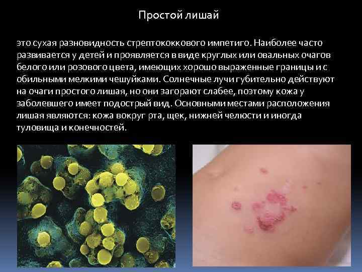 Простой лишай это сухая разновидность стрептококкового импетиго. Наиболее часто развивается у детей и проявляется