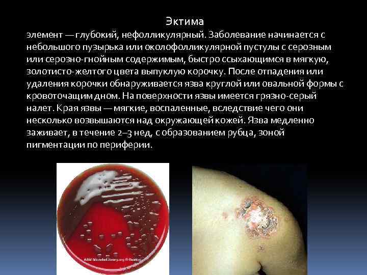 Эктима элемент — глубокий, нефолликулярный. Заболевание начинается с небольшого пузырька или околофолликулярной пустулы с
