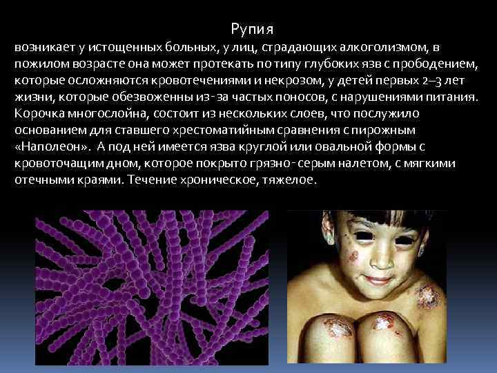  Рупия возникает у истощенных больных, у лиц, страдающих алкоголизмом, в пожилом возрасте она