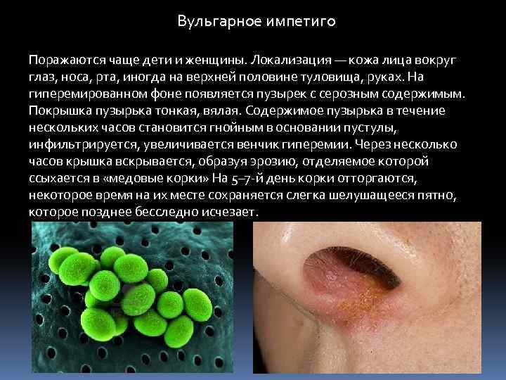  Вульгарное импетиго Поражаются чаще дети и женщины. Локализация — кожа лица вокруг глаз,