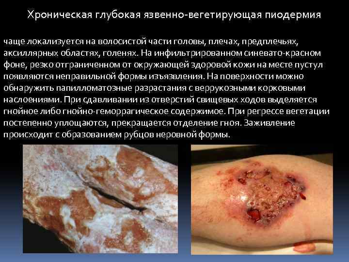 Хроническая глубокая язвенно-вегетирующая пиодермия чаще локализуется на волосистой части головы, плечах, предплечьях, аксиллярных областях,
