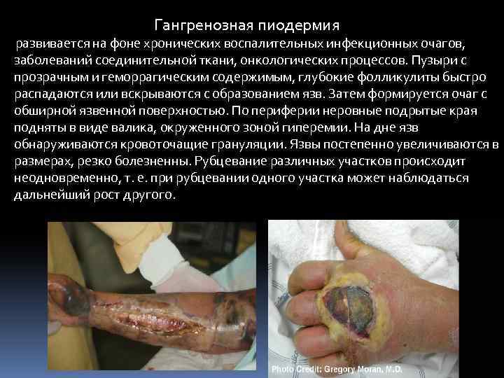 Гангренозная пиодермия развивается на фоне хронических воспалительных инфекционных очагов, заболеваний соединительной ткани, онкологических процессов.