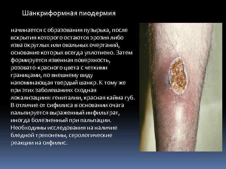 Шанкриформная пиодермия начинается с образования пузырька, после вскрытия которого остаются эрозия либо язва округлых