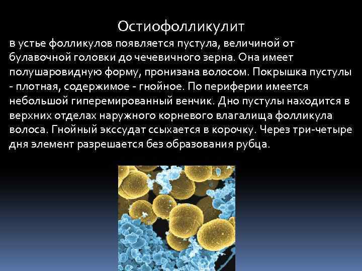 Остиофолликулит в устье фолликулов появляется пустула, величиной от булавочной головки до чечевичного зерна. Она