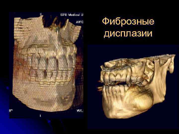 Фиброзные дисплазии 