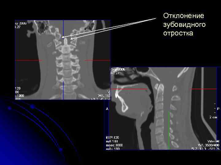 Отклонение зубовидного отростка 