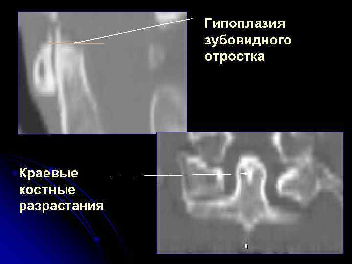 Гипоплазия зубовидного отростка Краевые костные разрастания 