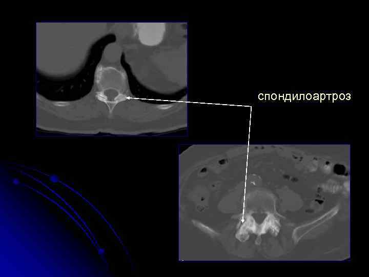 спондилоартроз 