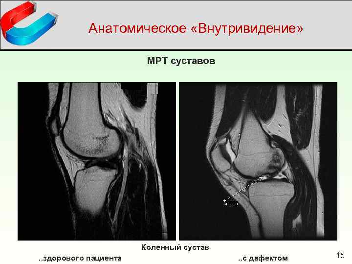 Анатомическое «Внутривидение» МРТ суставов Коленный сустав. . здорового пациента . . с дефектом 15