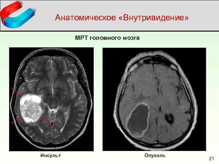 Анатомическое «Внутривидение» МРТ головного мозга Инсульт Опухоль 21 