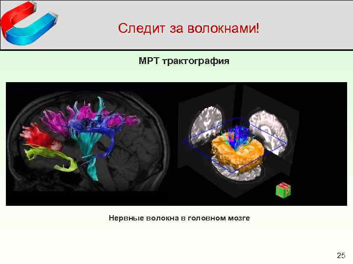 Следит за волокнами! МРТ трактография Нервные волокна в головном мозге 25 