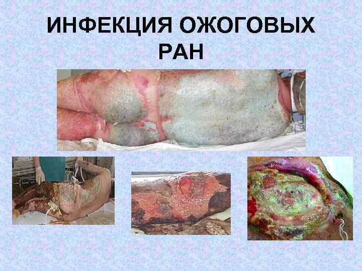 ИНФЕКЦИЯ ОЖОГОВЫХ РАН 