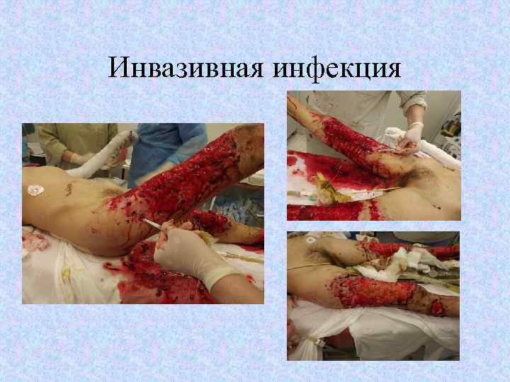 Инвазивная инфекция 