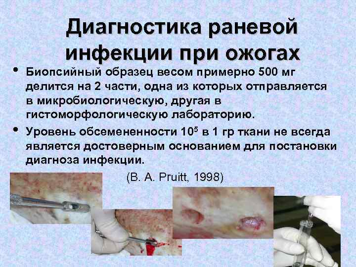  • • Диагностика раневой инфекции при ожогах Биопсийный образец весом примерно 500 мг