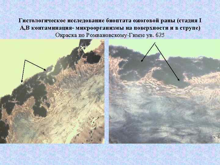 Гистологическое исследование биоптата ожоговой раны (стадия I A, B контаминация- микроорганизмы на поверхности и