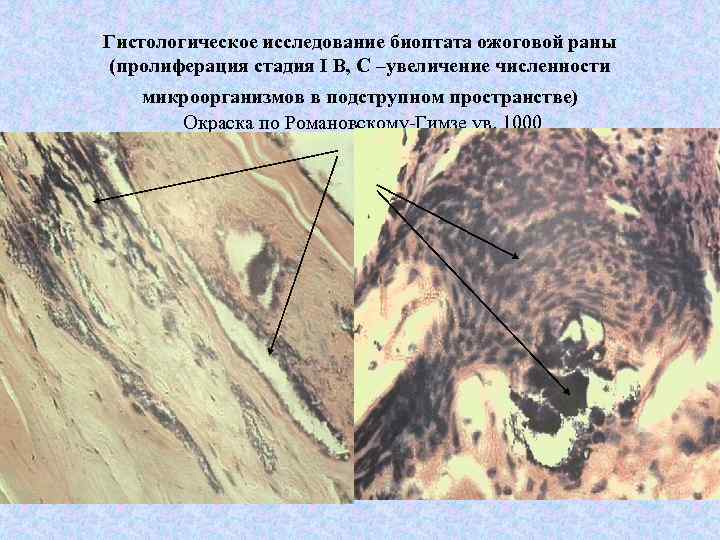 Гистологическое исследование биоптата ожоговой раны (пролиферация стадия I B, C –увеличение численности микроорганизмов в