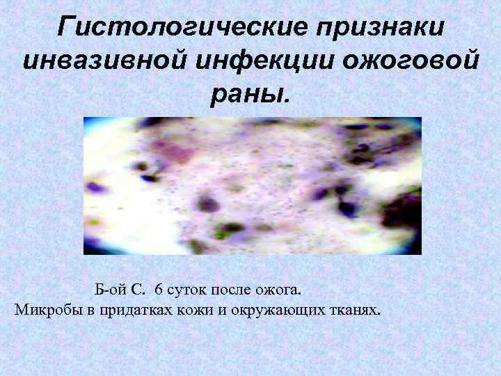 Гистологические признаки инвазивной инфекции ожоговой раны. Б-ой С. 6 суток после ожога. Микробы в