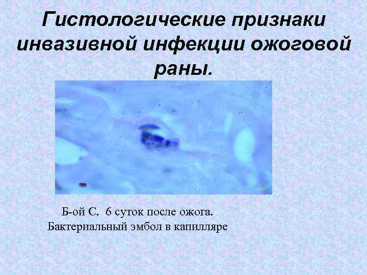Гистологические признаки инвазивной инфекции ожоговой раны. Б-ой С. 6 суток после ожога. Бактериальный эмбол