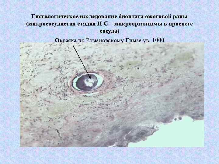 Гистологическое исследование биоптата ожоговой раны (микрососудистая стадия II C – микроорганизмы в просвете сосуда)