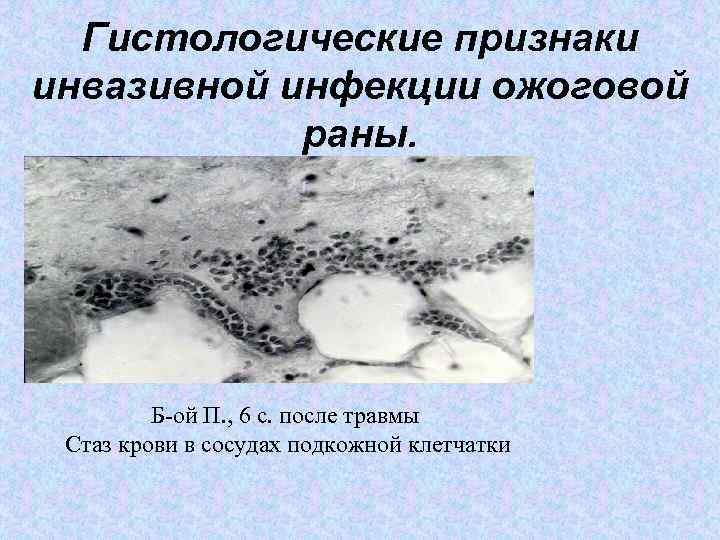 Гистологические признаки инвазивной инфекции ожоговой раны. Б-ой П. , 6 с. после травмы Cтаз