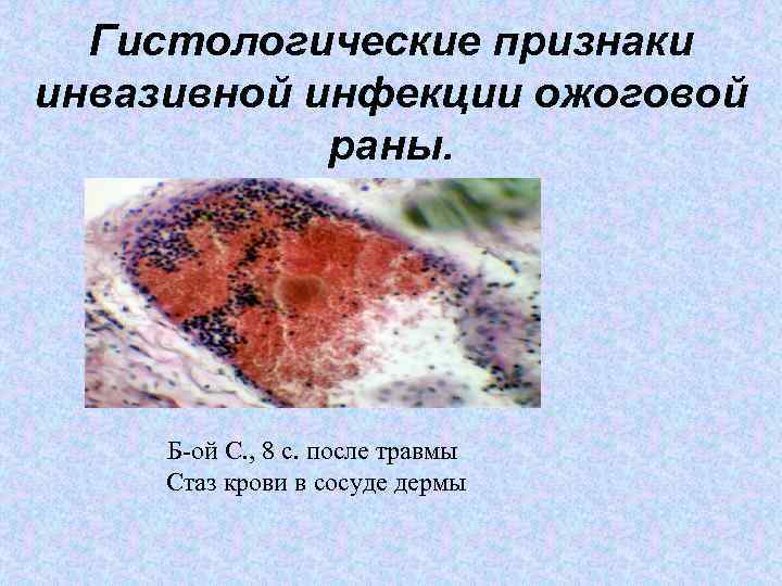 Гистологические признаки инвазивной инфекции ожоговой раны. Б-ой С. , 8 с. после травмы Cтаз