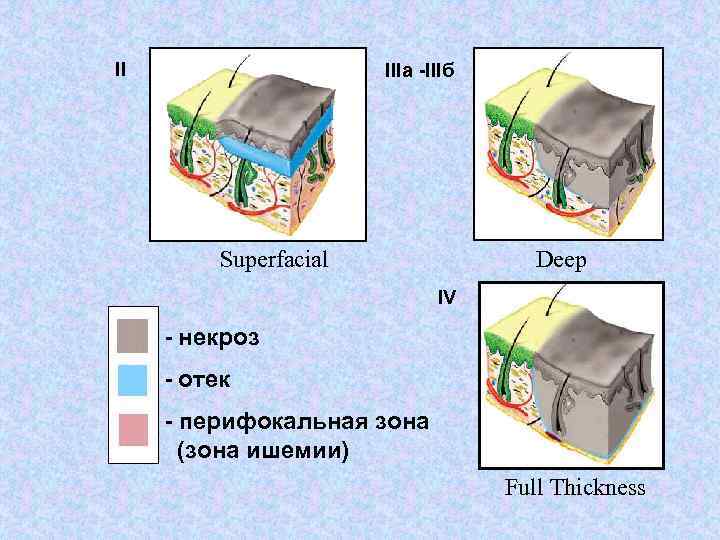 II IIIa -IIIб Superfacial Deep IV - некроз - отек - перифокальная зона (зона