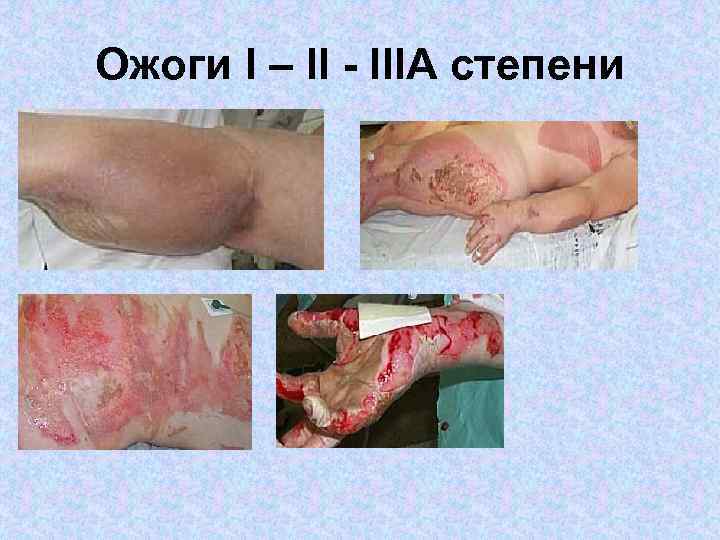 Ожоги I – II - IIIА степени 
