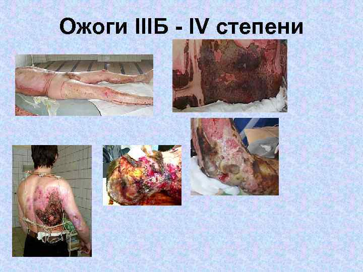 Ожоги IIIБ - IV степени 