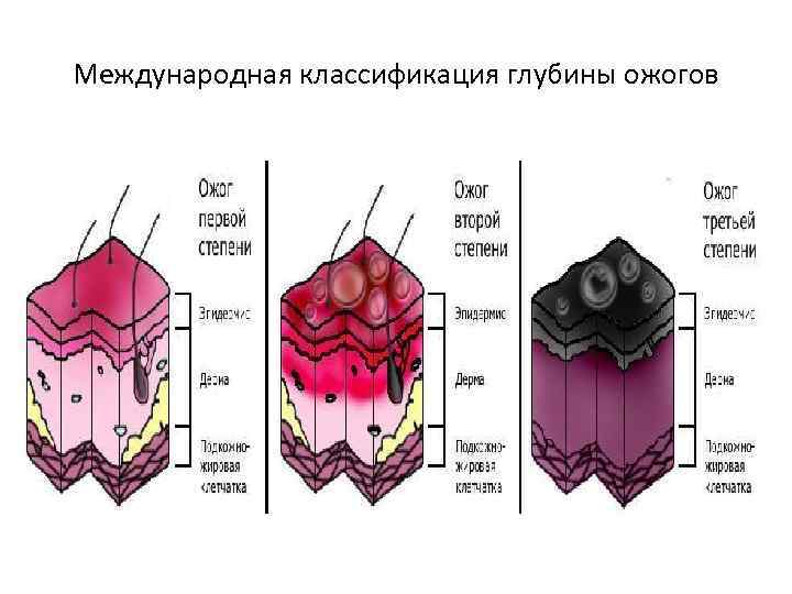 Международная классификация глубины ожогов 