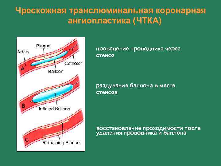 Чрескожная транслюминальная коронарная ангиопластика (ЧТКА) проведение проводника через стеноз раздувание баллона в месте стеноза